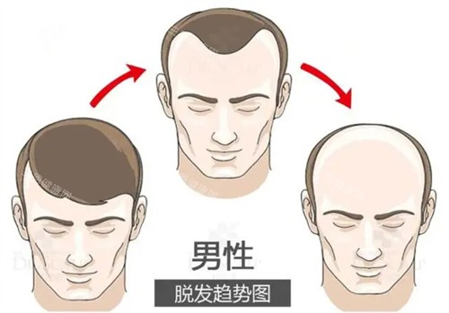 脱发趋势图 脱发趋势图
