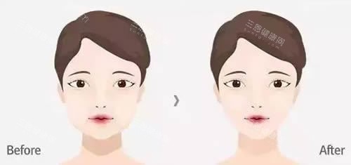 面部轮廓整形前后对比图