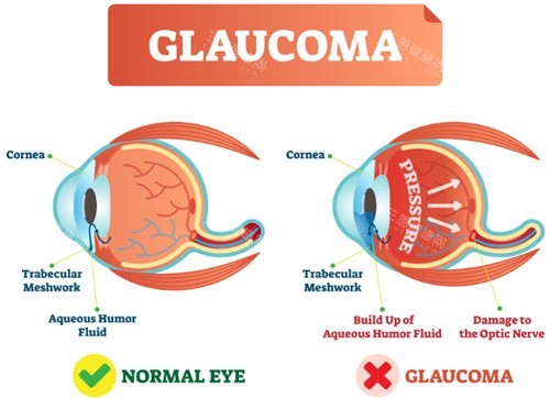 正常眼睛和青光眼的对比