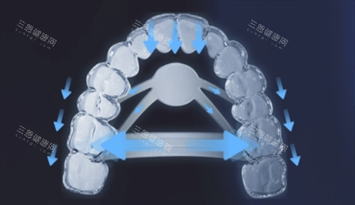 正雅隐形矫正s11牙齿位移变化