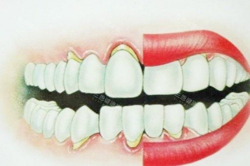 正常牙齿与牙龈萎缩牙齿卡通对比图