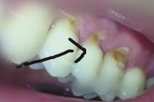 牙齿楔状缺损实拍图