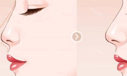 垫鼻子的前后对比动画图