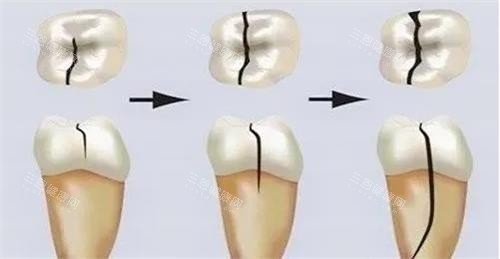 牙齿裂纹的发展过程