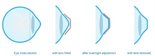 角膜塑形镜可以改善眼表曲度