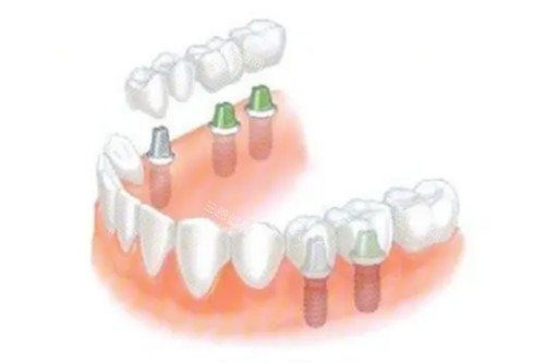 佛山禅医口腔医院种牙便宜不？种一颗牙 3k 起，价格完全匹配技术！