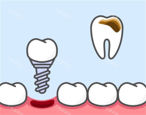 牙齿坏了换种植牙