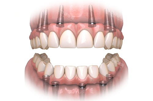 all-on-6全口种植牙示意图