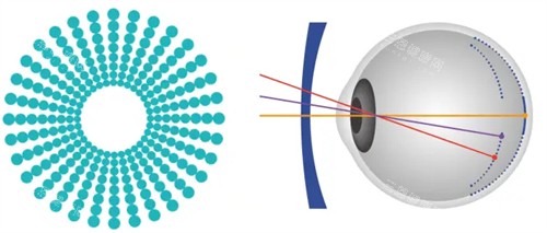 奥拉怒放离焦镜片原理 奥拉怒放离焦镜片原理