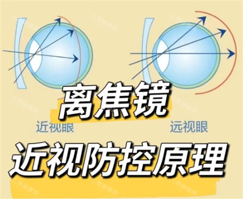 离焦镜片防控原理 离焦镜片防控原理