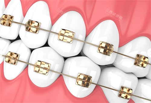 金属牙齿矫正