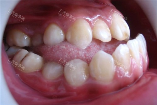 地包天牙齿照片