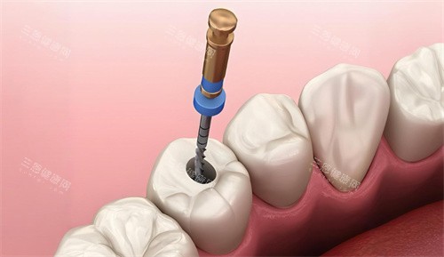 根管治疗过程展示