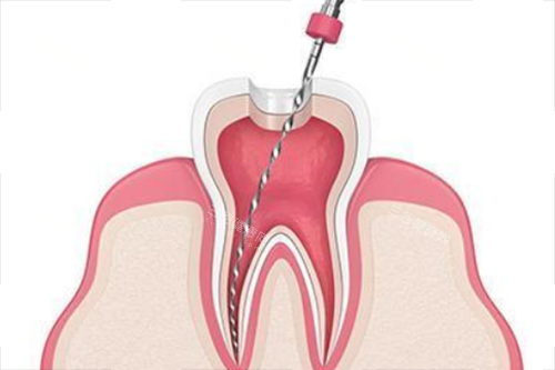 根管治疗卡通示意图 根管治疗卡通示意图