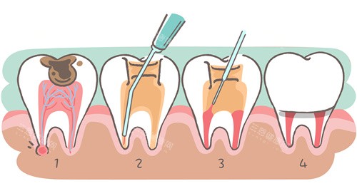 牙齿根管治疗步骤 牙齿根管治疗步骤