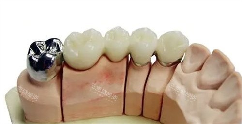 不同种类的烤瓷牙 不同种类的烤瓷牙