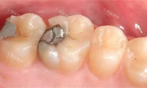 牙齿金属补牙图 牙齿金属补牙图