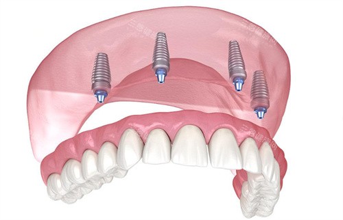 种植牙动画示意图片 种植牙动画示意图片