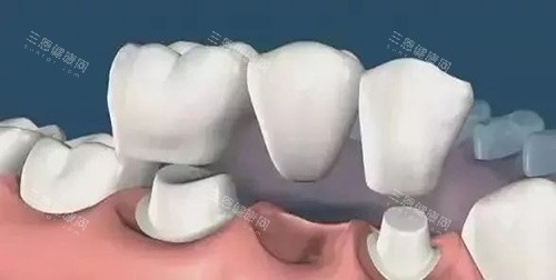 固定假牙连桥示意图