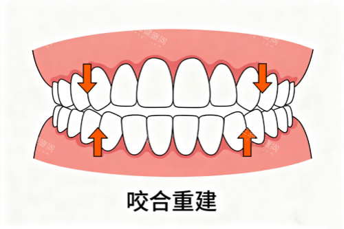 牙齿咬合重建卡通展示图