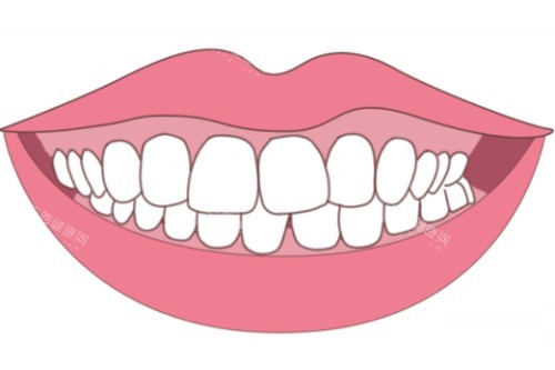 牙齿轻微畸形卡通图片展示