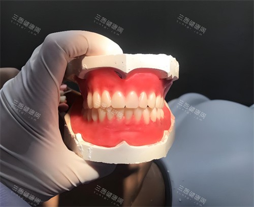 全口义齿模型
