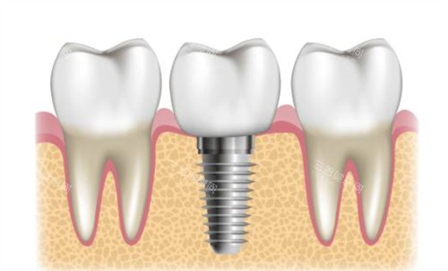 种植牙周围健康牙