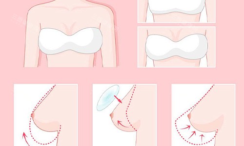 隆胸的流程展示
