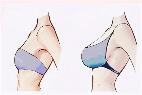 假体隆胸的前后对比图