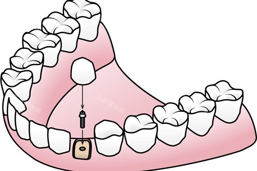 种植牙安装牙冠卡通图 种植牙安装牙冠卡通图