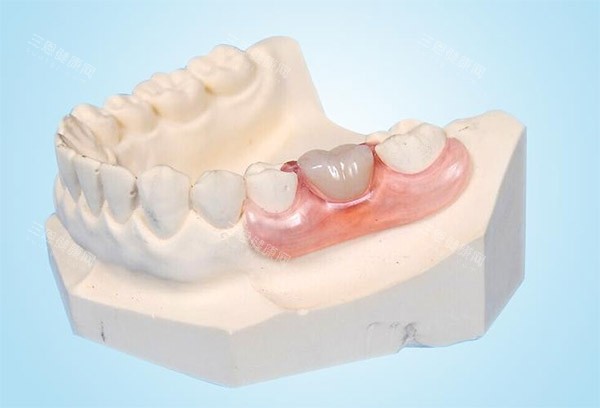 镶牙示意图 镶牙示意图