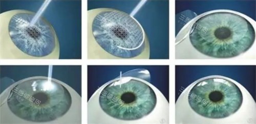 全飞秒近视手术过程详细图解 全飞秒近视手术过程详细图解