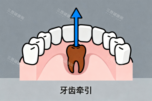 牙齿牵引卡通图