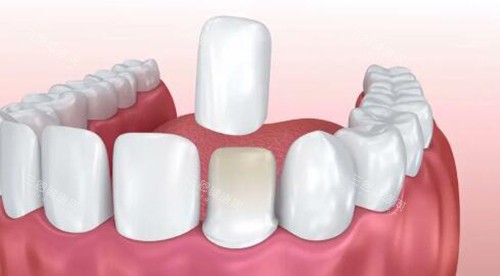 亲测！成都中诺口腔牙贴面结果惊人，从“黄牙妹”到“微笑女神”的华丽转变！