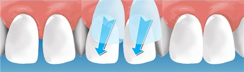 门牙贴面过程 门牙贴面过程