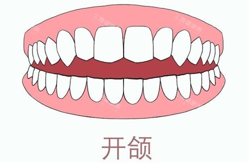 牙齿开颌