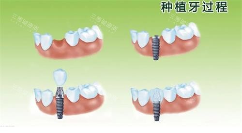 种植牙的过程 种植牙的过程
