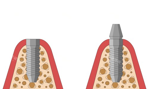 种植牙桩体展示 种植牙桩体展示