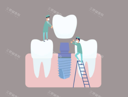 种植牙检查示意图 种植牙检查示意图