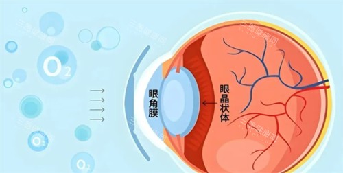 角膜塑形镜佩戴方法 角膜塑形镜佩戴方法