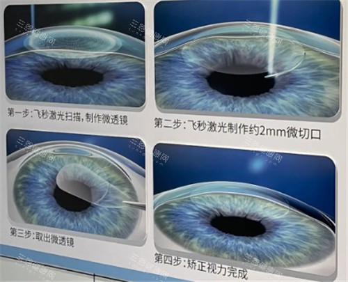 飞秒手术过程图 飞秒手术过程图