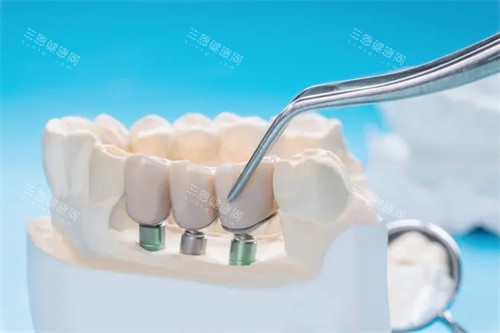 上海西郊众植口腔种植牙怎么样？种牙贵吗？种牙1980起|医生技术靠谱