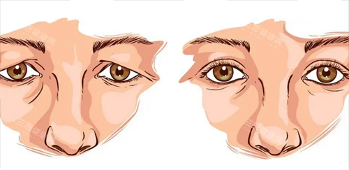 双眼皮修复前后 双眼皮修复前后
