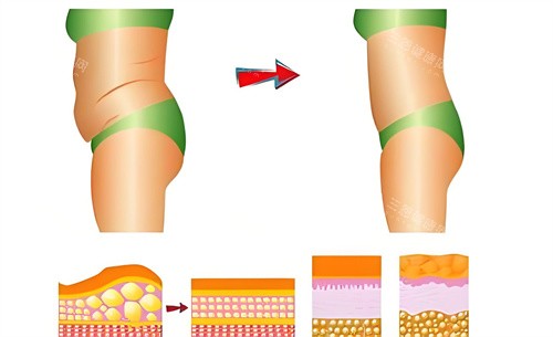 【北京冯斌医生吸脂预约方式】提供在线预约、电话预约等方式/附冯斌医生吸脂价格表
