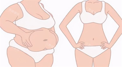 腹部吸脂前后对比过程 腹部吸脂前后对比过程