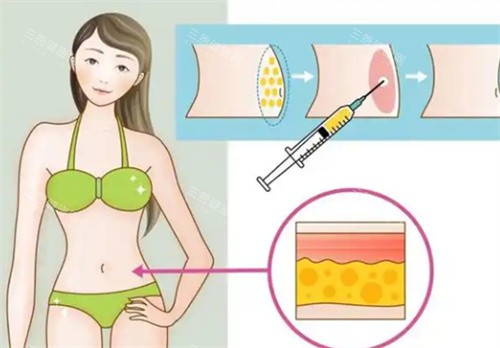 吸脂手术腰部 吸脂手术腰部