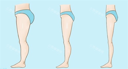 腿部吸脂瘦身前后 腿部吸脂瘦身前后