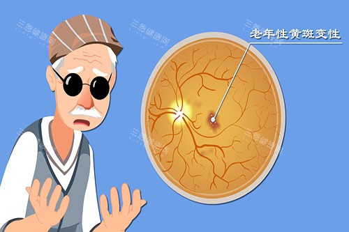 老年性黄斑病变卡通图