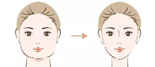 瘦脸手术前后对比动画图