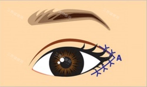 割眼角后示意图 割眼角后示意图